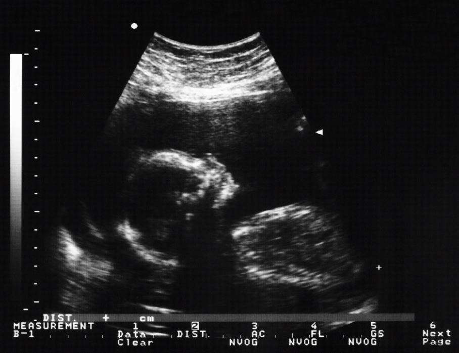 amniocentesis