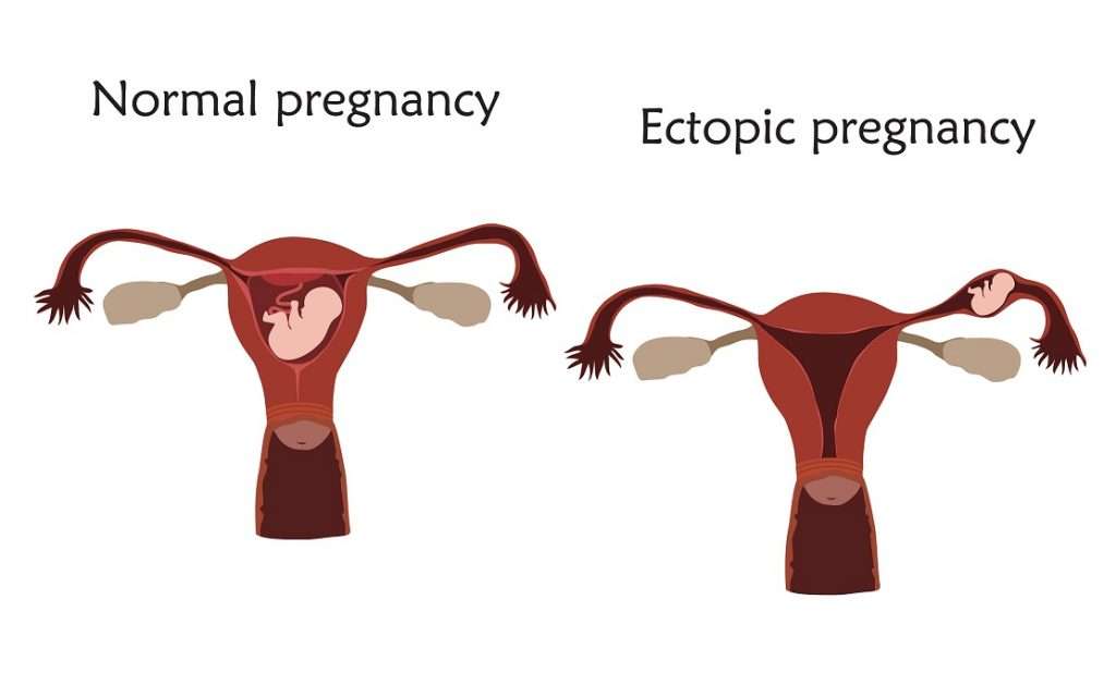 Grossesse Extra Utérine Symptômes Risques Et Traitements 