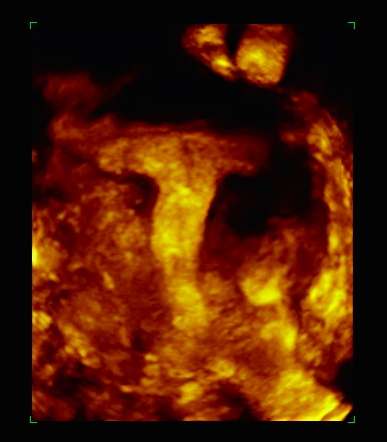 Investigacion IVI sobre utero en T