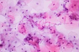 Infecciones del aparato reproductor y sus efectos sobre la fertilidad femenina