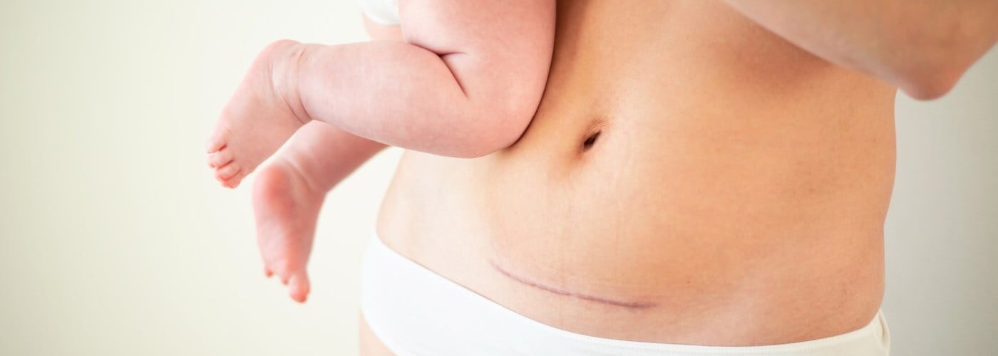 embarazo tras cesárea