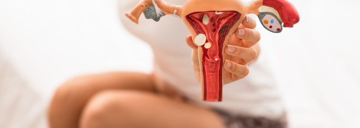 tratamiento endometriosis